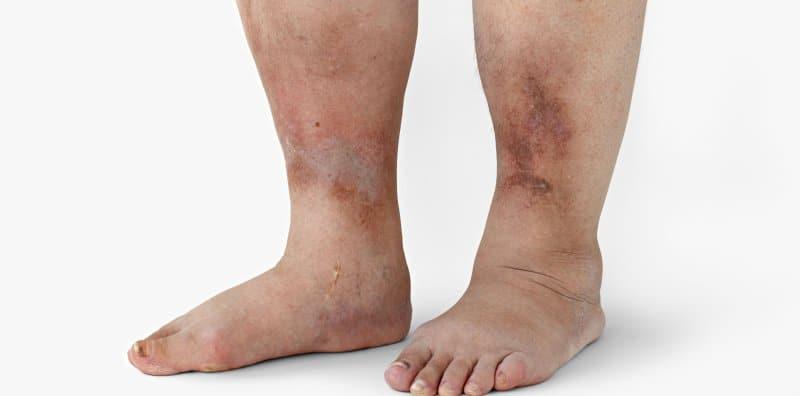 Kaki Bengkak Kerana Diabetes? Cuba 5 Petua Ini Untuk Surutkan Bengkak Anda!
