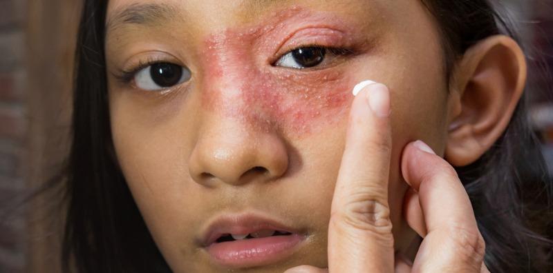 Ada Kurap Kering Di Kulit? Hilangkan Kegatalan Dan Parut Dengan 5 Cara Ini!