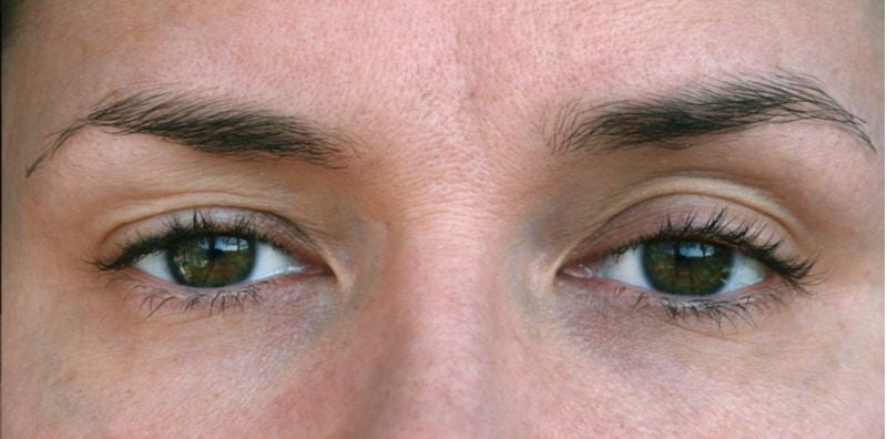 mata-sepet-punca-rawatan