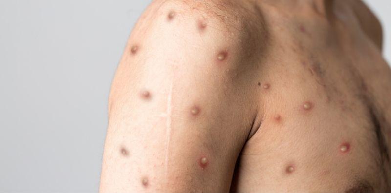 Ruam Cacar Monyet Serupa Dengan Cacar Air? Ini 5 Fakta Penting Tentang Monkeypox!