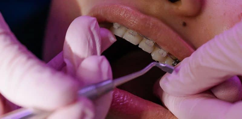 jenis-gigi-yang-tak-boleh-pakai-braces