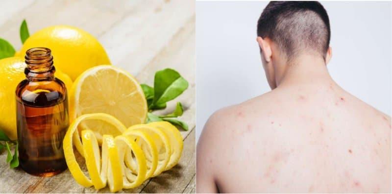 Hilangkan Jerawat Badan Dengan 6 Bahan Natural Ini, Selamat Dan Berkesan!