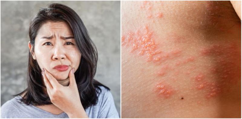 Awas! Sindrom Ramsay Hunt, Kayap Dan Chickenpox Berpunca Daripada Virus Yang Sama!