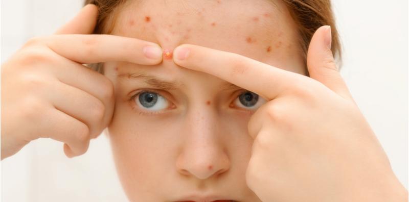 Masalah Jerawat Di Dahi? Ini Punca Dan Cara Atasinya