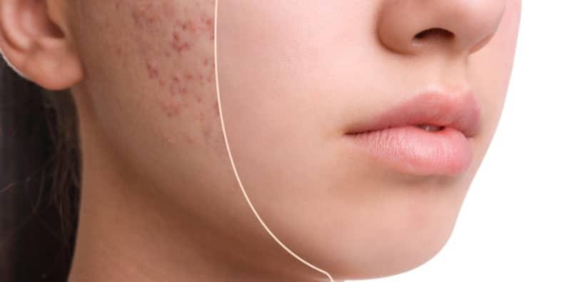 Parut Jerawat Susah Nak Hilang? Amalkan Serum Yang Ada 8 Bahan Ini, Berkesan!
