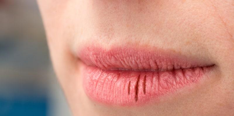 Jangan Abaikan Kalau Bibir Selalu Kering Dan Pecah, Ia Mungkin Tanda Cheilitis!
