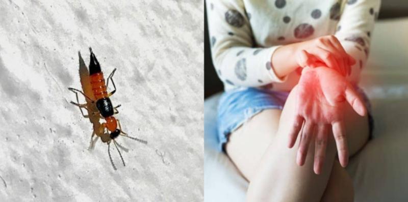 gigitan-semut-charlie