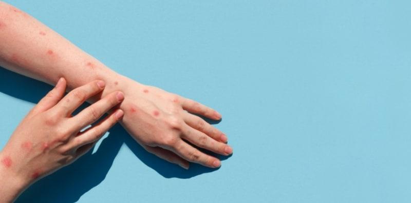 Sama Tapi Tak Serupa! Ini 6 Perbezaan Utama Antara Monkeypox Dan Chickenpox