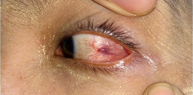 Soal Jawab Doktor: Jangkitan Cacing Pipih Boleh Merebak Ke Mata?