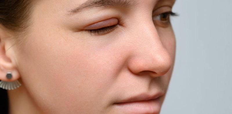 Bangun Tidur Tengok Mata Sembap? Ini 10 Punca Mata Bengkak Secara Tiba-tiba