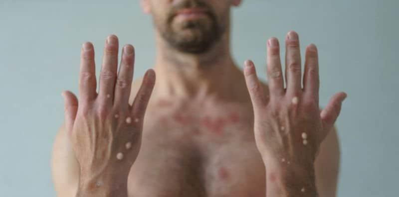 Penghidap Monkeypox Boleh Meninggal Dunia? Kenal Pasti Simptomnya Sebelum Terlambat!